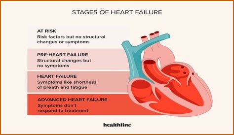 Heart Failure And The Plight Of Extreme Obesity